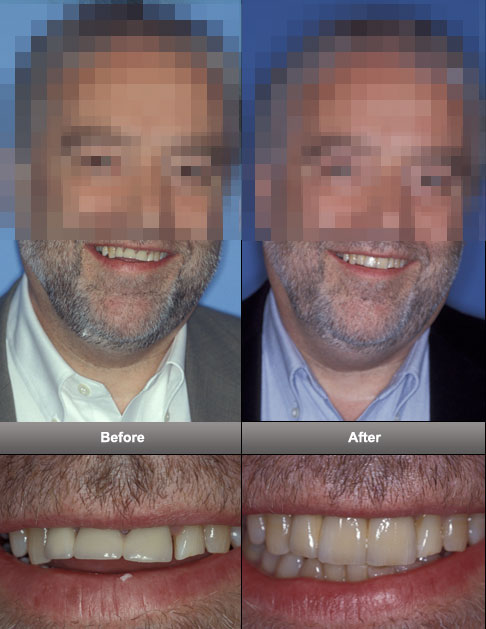 dental_implants