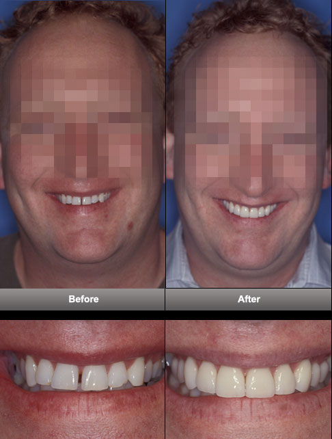 dental_makeover