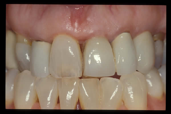 Occlusal and TMD treatments