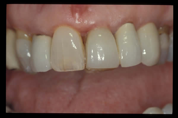 Occlusal and TMD treatments