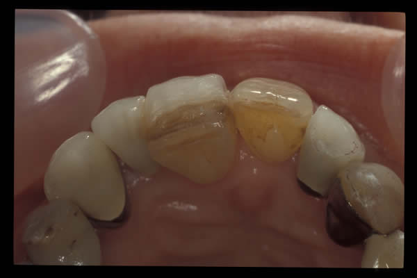 Occlusal and TMD treatments