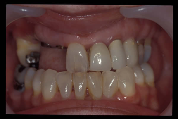 Occlusal and TMD treatments