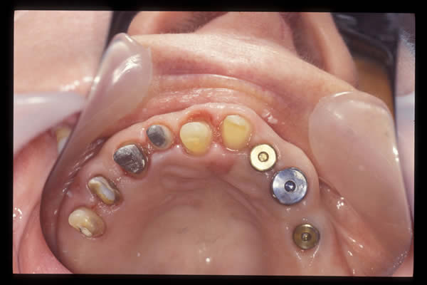 Occlusal and TMD treatments