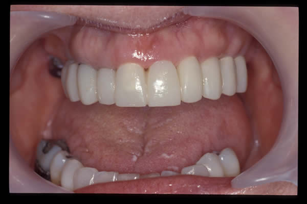 Occlusal and TMD treatments