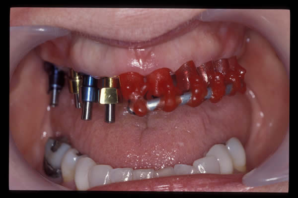 Occlusal and TMD treatments