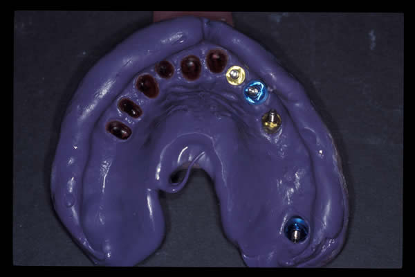 Occlusal and TMD treatments