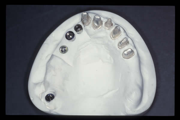 Occlusal and TMD treatments