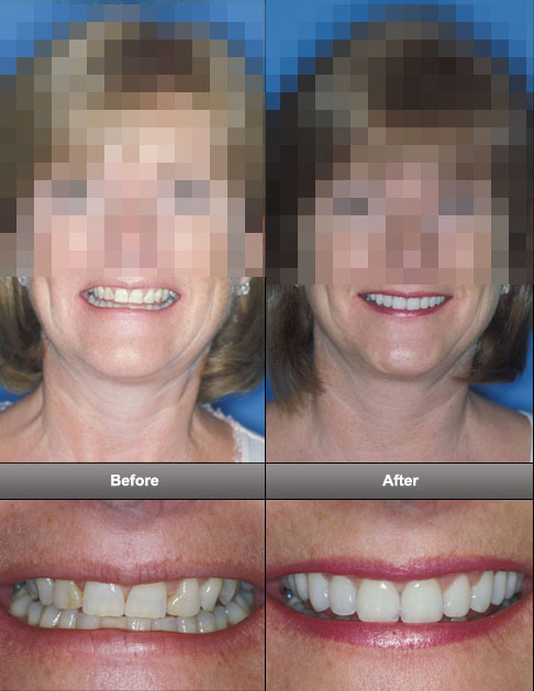 dental_facelift